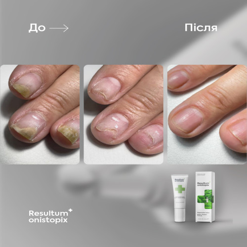 Onistopix Lotion, 10 ml Resultum