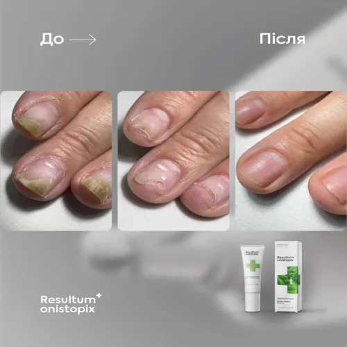Onistopix Lotion, 10 ml Resultum