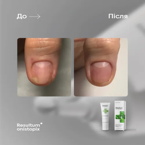 Onistopix Lotion, 10 ml Resultum
