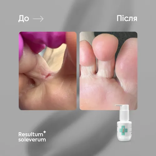 Soleverum, 150 ml Resultum